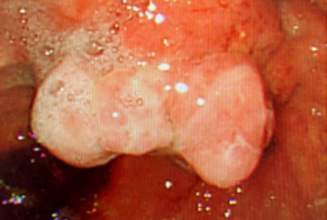 胃がん（内視鏡画像）