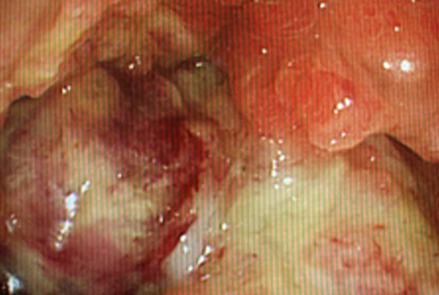 大腸がん（大腸内視鏡画像）