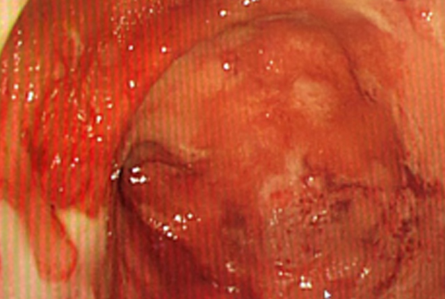 潰瘍性大腸炎（大腸内視鏡画像）
